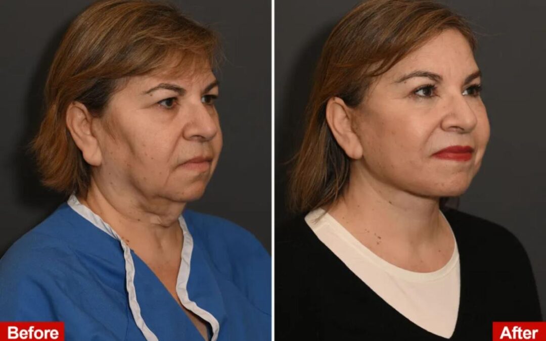 NYC women drop $100K on risky gland-shaving surgery, transforming into younger, ‘more snatched’ bombshells