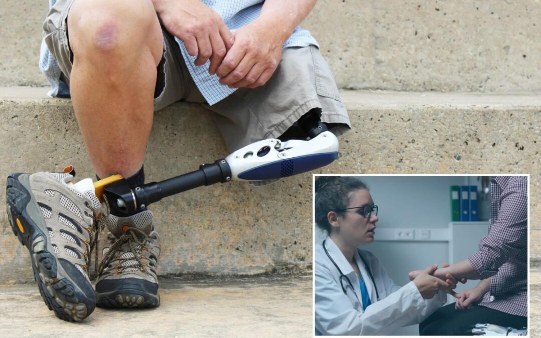 Amputation rates are on the rise — especially among a surprising at-risk population