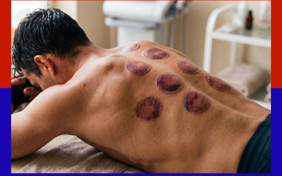 This ancient therapy leaves you with mysterious bruises — but users say it melts away pain